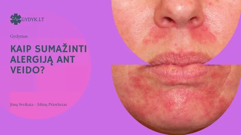 Kaip sumažinti alergiją ant veido?