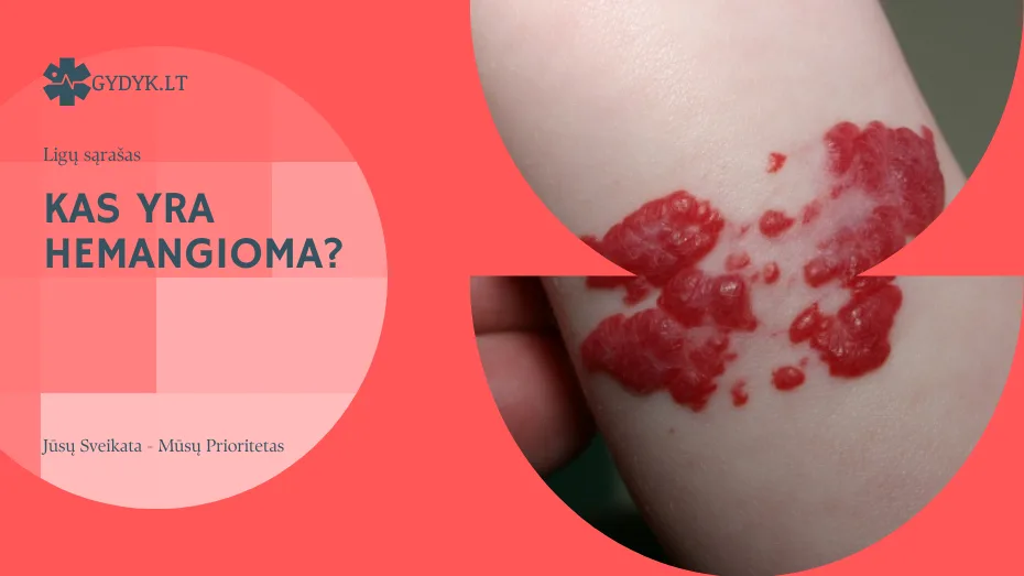 Kas yra hemangioma