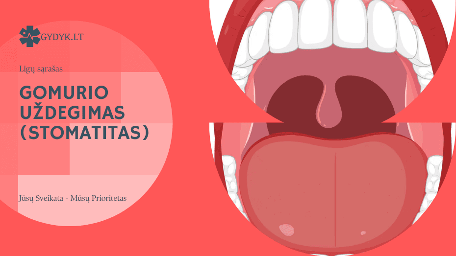 Gomurio uždegimas (Stomatitas): kas tai, kokie simptomai ir kaip gydyti? Gomurio uždegimas (Stomatitas)
