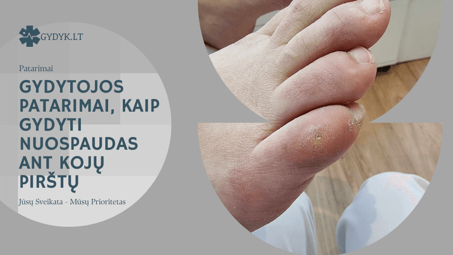 Gydytojos patarimai, kaip gydyti nuospaudas ant kojų pirštų Gydytojos patarimai, kaip gydyti nuospaudas ant kojų pirštų