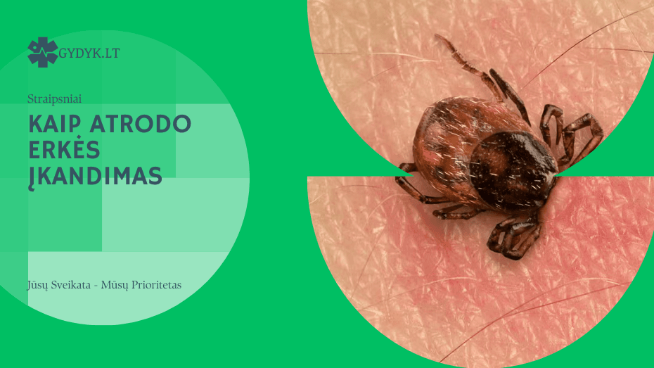 Kaip atrodo erkės įkandimas