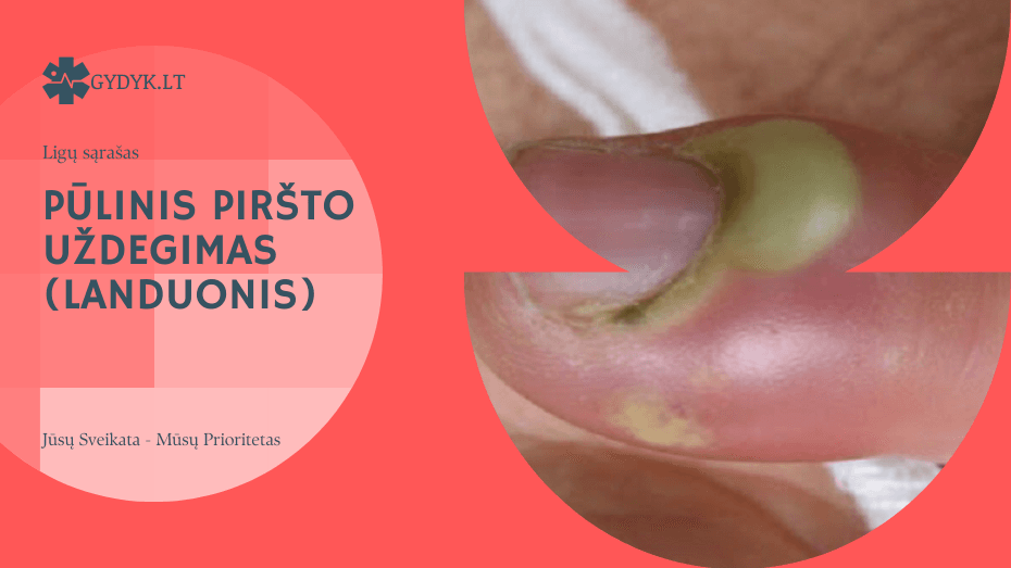 Pūlinis piršto uždegimas (landuonis) – kas tai, kokie simptomai ir kaip gydyti? Pūlinis piršto uždegimas (landuonis)