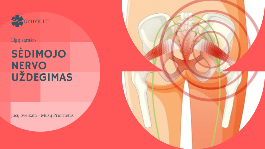 Sėdimojo nervo uždegimas: kokie pratimai labiausiai padeda? Sėdimojo nervo uždegimas