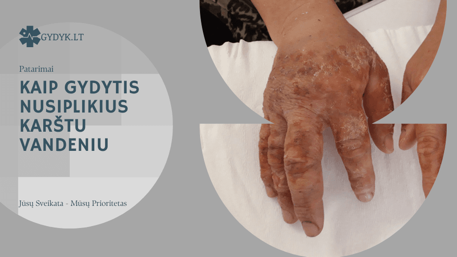 Ką daryti arba kaip gydytis nusiplikius karštu vandeniu? kaip gydytis nusiplikius karštu vandeniu