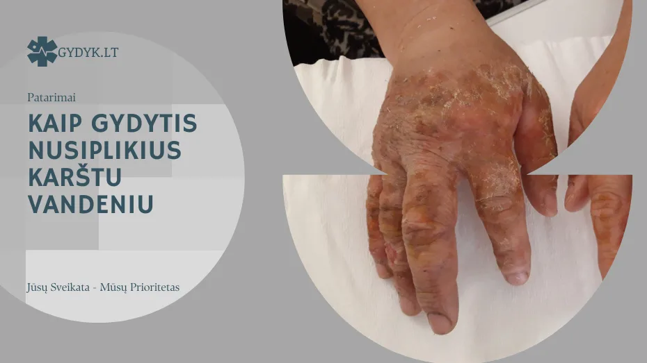 kaip gydytis nusiplikius karštu vandeniu