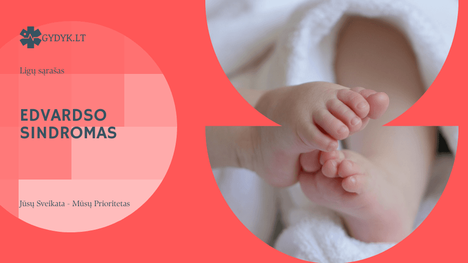 Edvardso sindromas: priežastys, požymiai, diagnozė, gydymas ir pagalba šeimai Edvardso sindromas