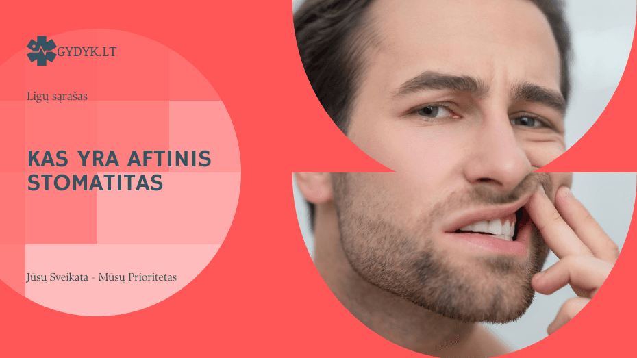 Kas yra aftinis stomatitas ir kodėl jis atsiranda? Kas yra aftinis stomatitas