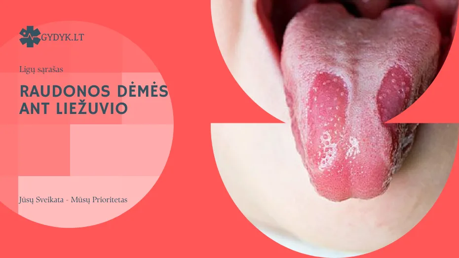 Raudonos dėmės ant liežuvio
