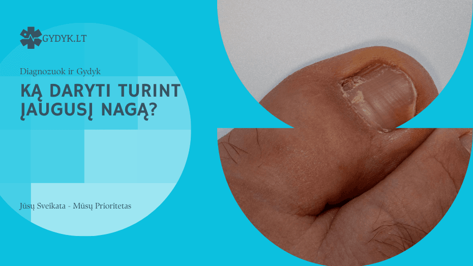 ką daryti turint įaugusį nagą