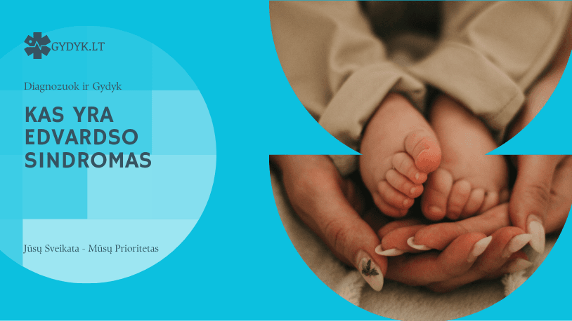Kas yra Edvardso sindromas, kaip jis diagnozuojamas, kokios priežastys ir galimas gydymas