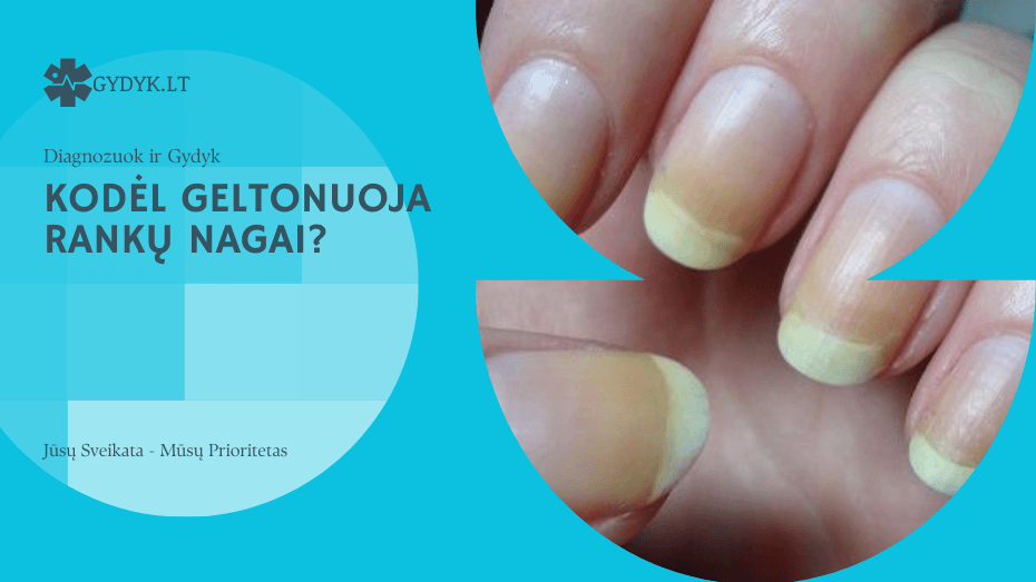 kodėl Geltonuoja rankų nagai