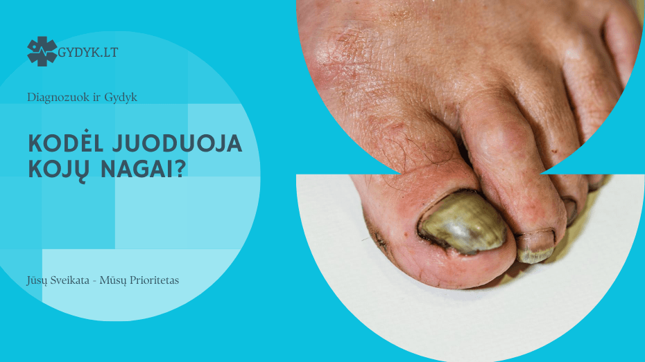 kodėl Juoduoja kojų nagai