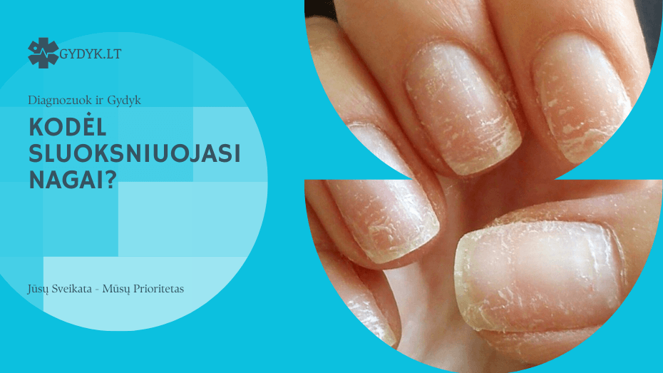 kodėl Sluoksniuojasi nagai?