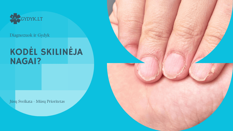 kodėl skilinėja nagai