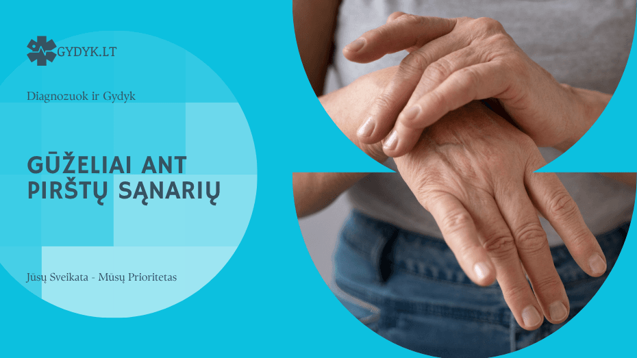 Guzeliai ant pirštų sąnarių: kas tai, kodėl atsiranda ir ką daryti