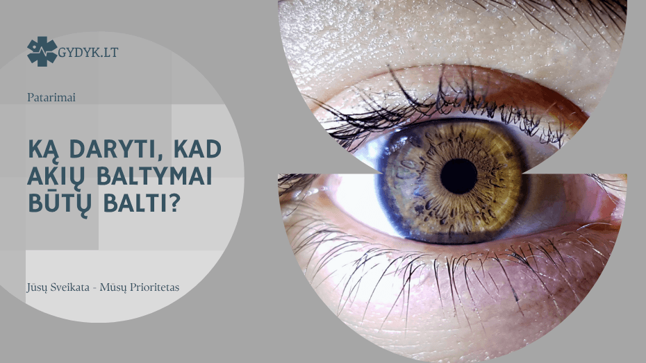 Ką daryti, kad akių baltymai būtų balti? Ką daryti, kad akių baltymai būtų balti?