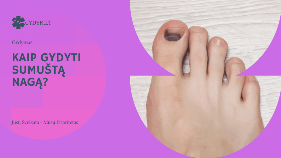 Sumuštas nagas: kaip gydyti? kaip gydyti sumuštą nagą?