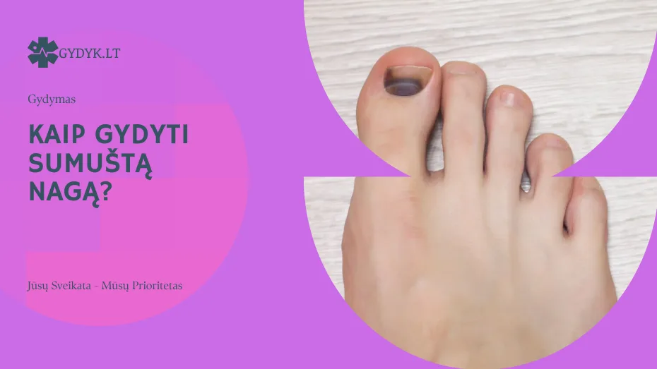 kaip gydyti sumuštą nagą?