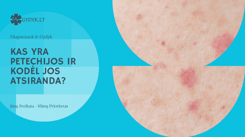 Kas yra petechijos ir kodėl jos atsiranda?