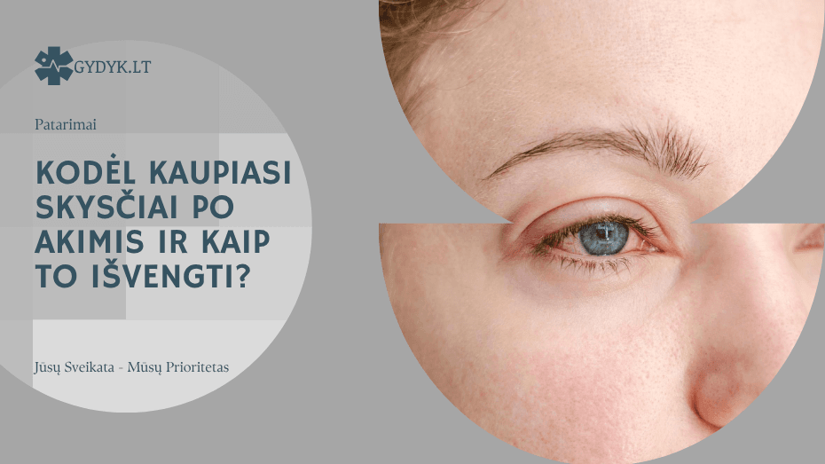 Kodėl kaupiasi skysčiai po akimis ir kaip to išvengti?