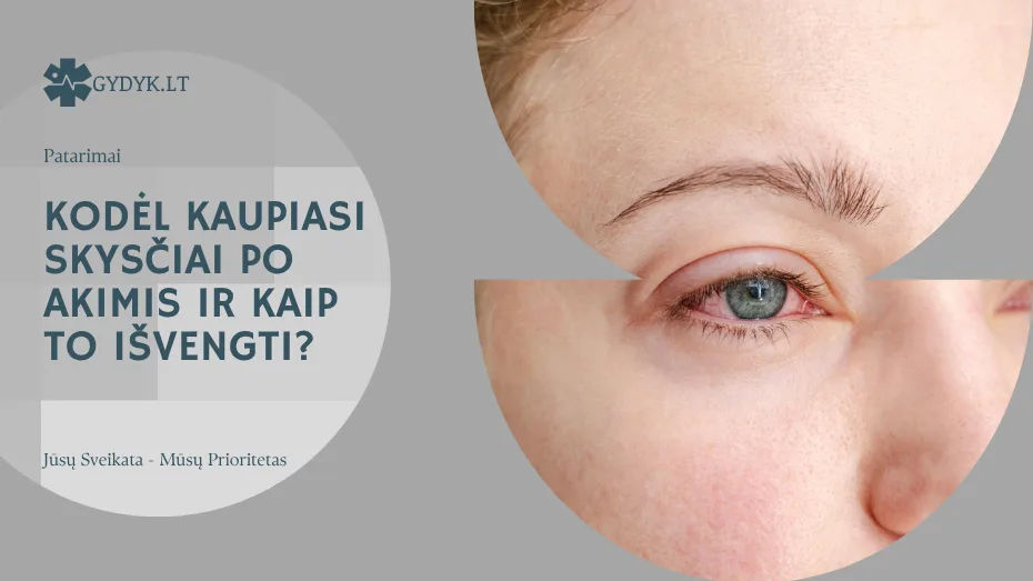 Kodėl kaupiasi skysčiai po akimis ir kaip to išvengti?