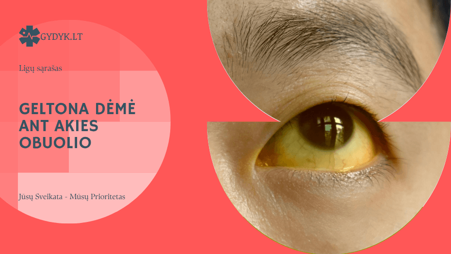 Geltona dėmė ant akies obuolio