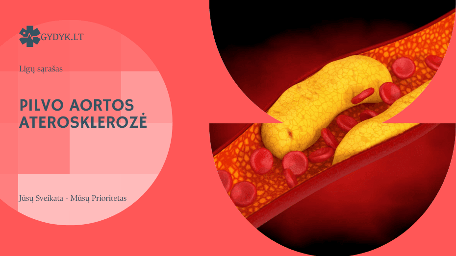 Pilvo aortos aterosklerozė