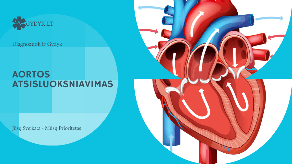 Aortos atsisluoksniavimas