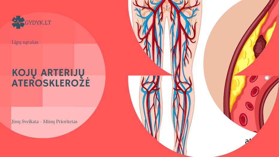 Kojų arterijų aterosklerozė