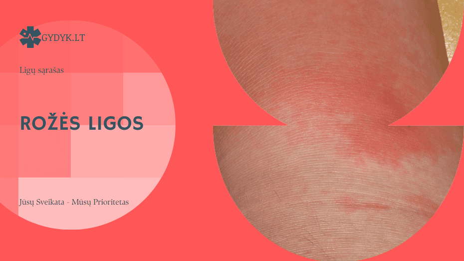 Rožės ligos (ant veido, kojos) nuotraukos: kaip atpažinti šią ligą?