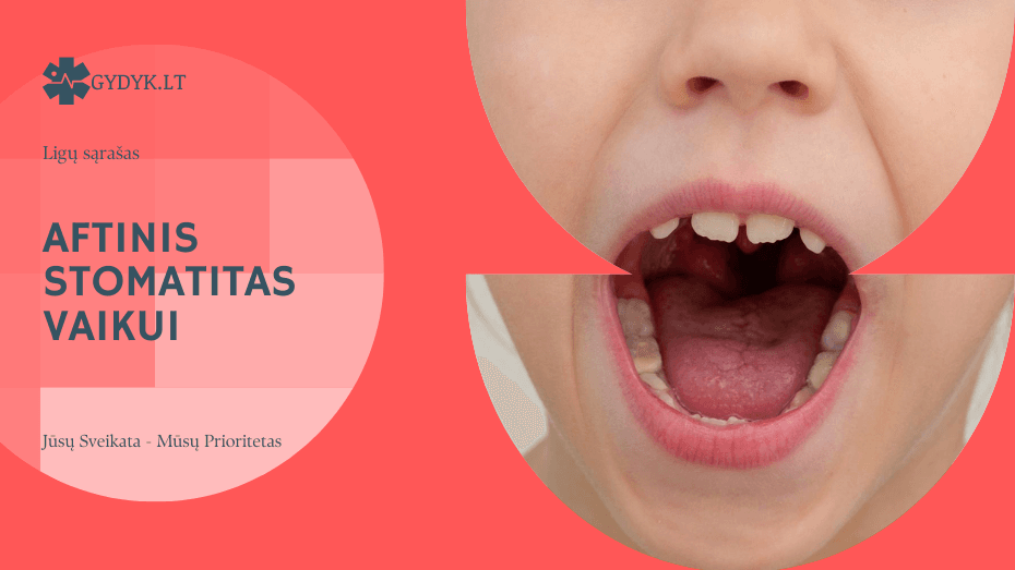 Aftinis stomatitas vaikui: priežastys, simptomai ir gydymo gairės