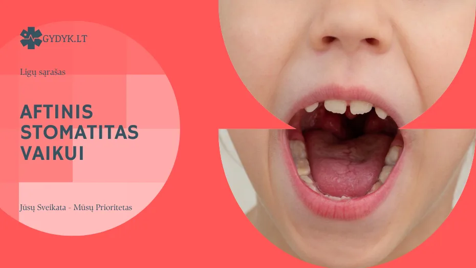 Aftinis stomatitas vaikui: priežastys, simptomai ir gydymo gairės Aftinis stomatitas vaikui: priežastys, simptomai ir gydymo gairės