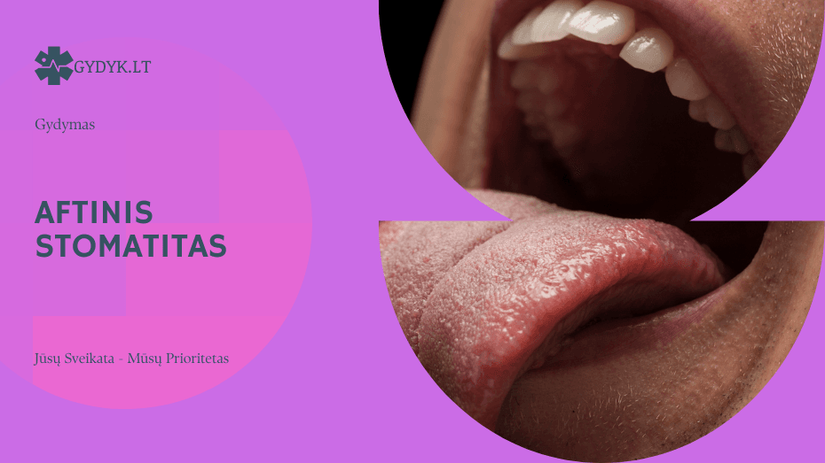 Aftinis stomatitas: priežastys, simptomai ir gydymo taktika