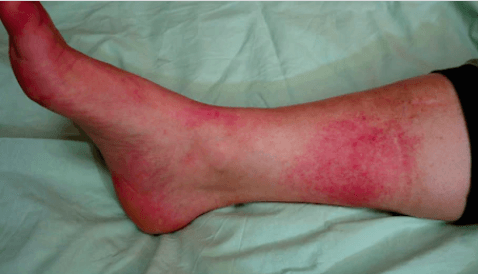 Rožės ligos (ant veido, kojos) nuotraukos: kaip atpažinti šią ligą?