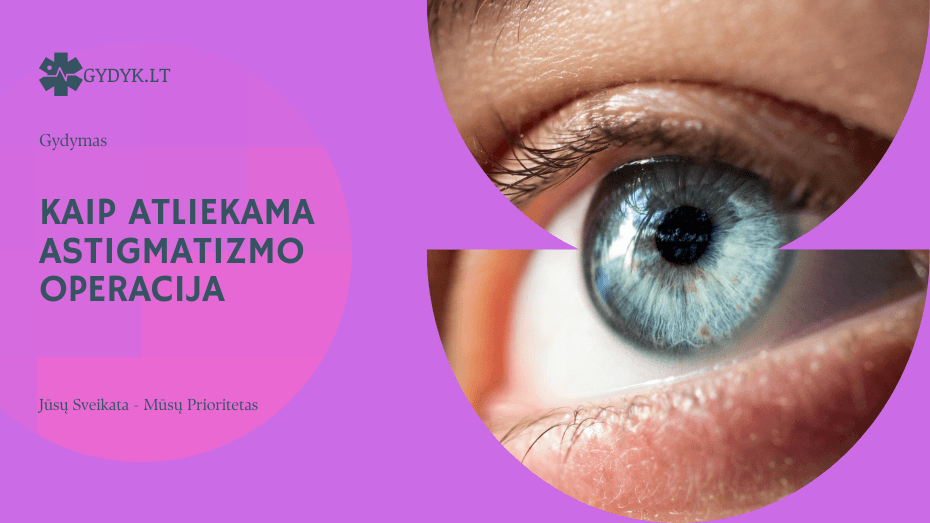 Kaip atliekama astigmatizmo operacija: technikos, rizikos ir atsigavimas Kaip atliekama astigmatizmo operacija: technikos, rizikos ir atsigavimas