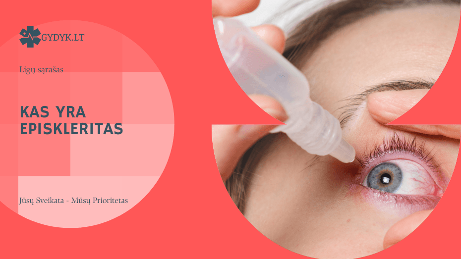 Kas yra episkleritas? Kokie požymiai ir gydymas?