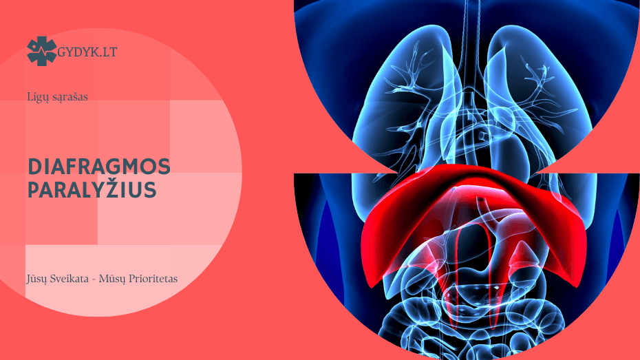 Diafragmos paralyžius: kas tai, simptomai ir gydymo galimybės