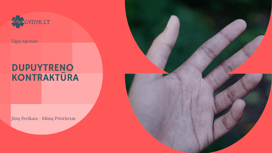 Dupuytreno kontraktūra: priežastys, simptomai ir gydymas Dupuytreno kontraktūra: priežastys, simptomai ir gydymas