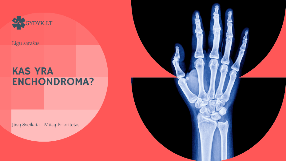 Kas yra enchondroma? Priežastys, simptomai ir gydymas