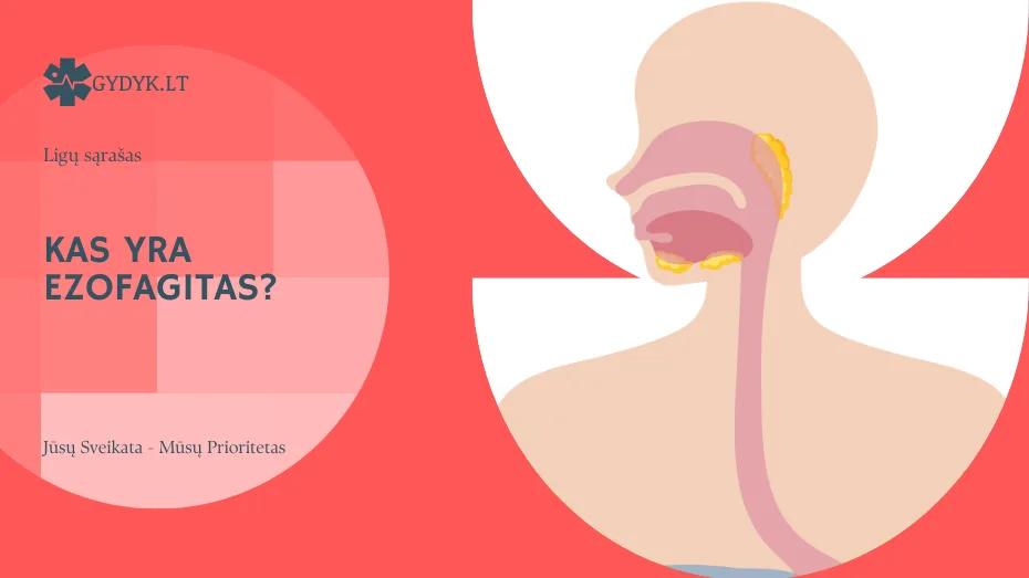 Kas yra ezofagitas? Tipai, priežastys, simptomai ir gydymas Kas yra ezofagitas? Tipai, priežastys, simptomai ir gydymas