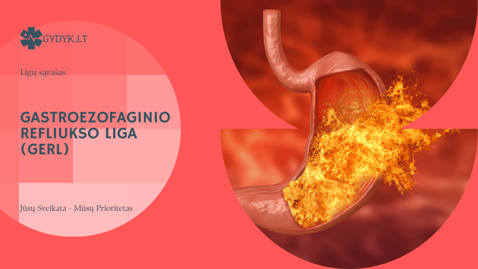 Gastroezofaginio refliukso liga (GERL): simptomai, priežastys ir gydymas