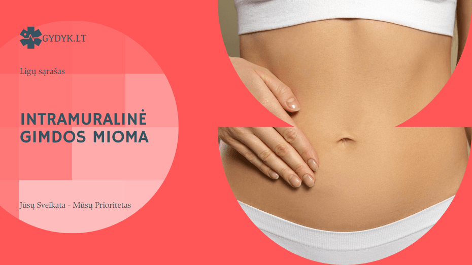 Intramuralinė gimdos mioma – kas tai yra, kokie simptomai ir kada reikia gydymo