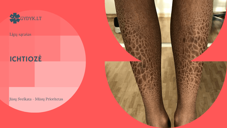 Ichtiozė: kas tai, simptomai, priežastys ir gydymas Ichtiozė