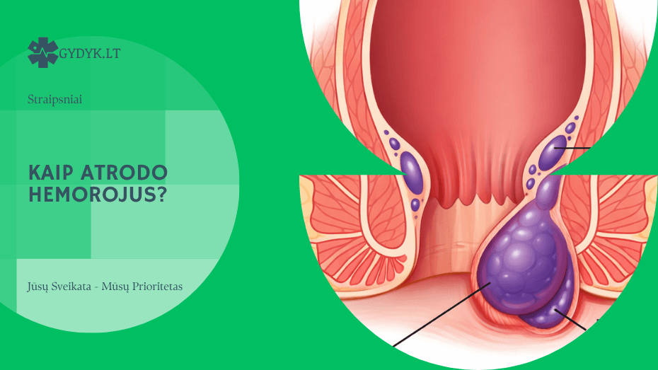 Kaip atrodo hemorojus