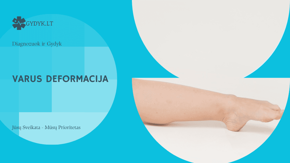 Varus deformacija: priežastys, diagnostika ir gydymo galimybės