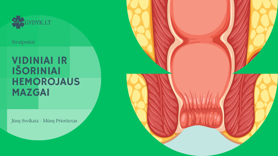 Vidiniai ir išoriniai hemorojaus mazgai kuo jie skiriasi