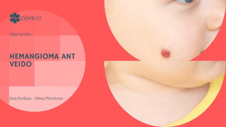 Hemangioma ant veido: gydymo galimybės ir estetiniai aspektai