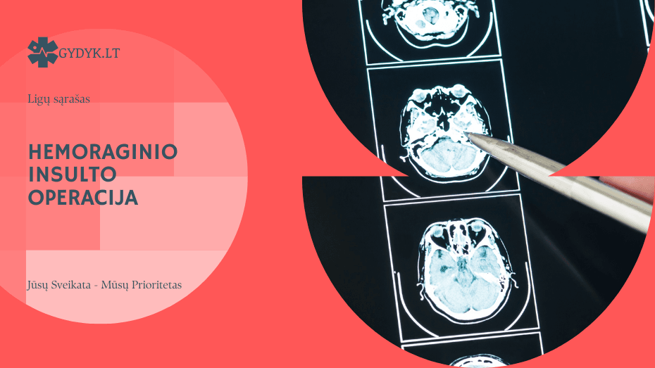 Hemoraginio insulto operacija: kada ji būtina ir kokios galimybės?