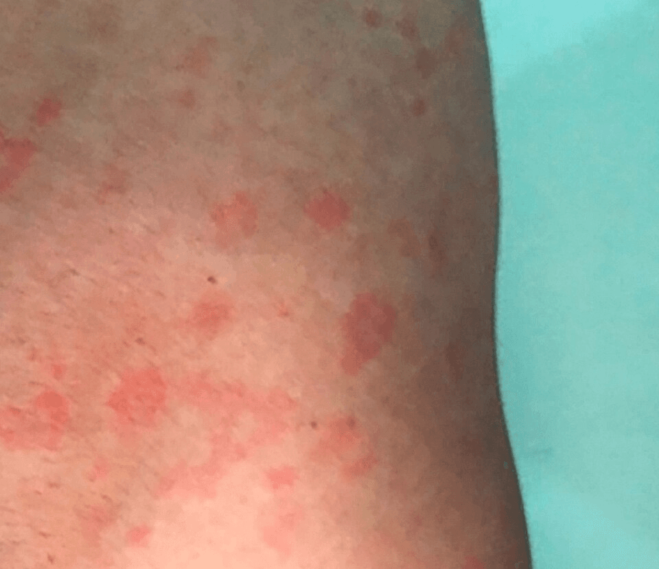 Sifilio požymiai: kaip atrodo bėrimas, simptomai vyrams ir moterims