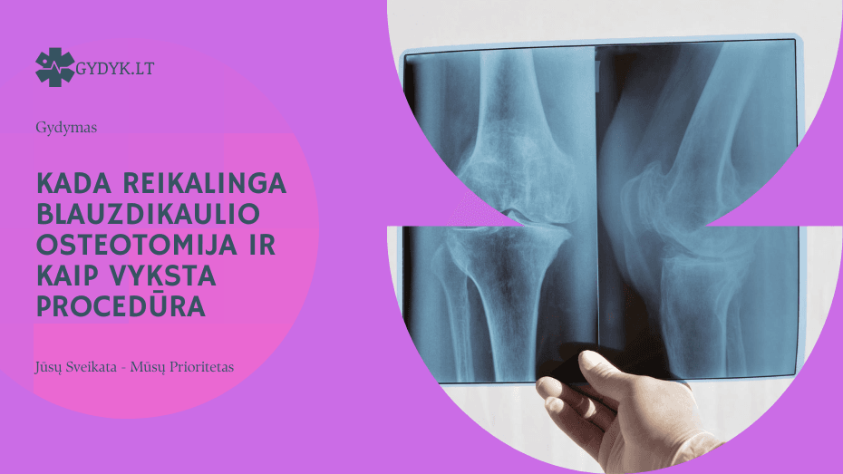 Kada reikalinga blauzdikaulio osteotomija ir kaip vyksta procedūra